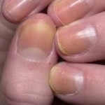 фото грибка ногтей на руках