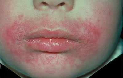 дерматит на лице у подростка фото