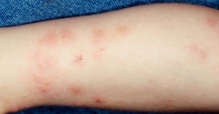 аллергический дерматит на руках фото