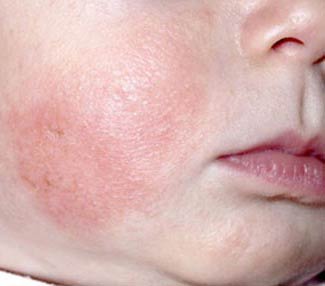 аллергический дерматит на лице у детей фото