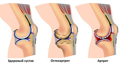 изменения, приводящие к боли в суставах ног 