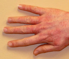 дерматит на пальцах рук фото
