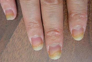 как выглядит грибок на ногтях рук фото