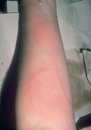 аллергия на холод - выделения при холодовой крапивнице