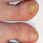 лечение грибка ногтей ног уксусом