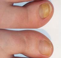 лечение грибка ногтей ног уксусом