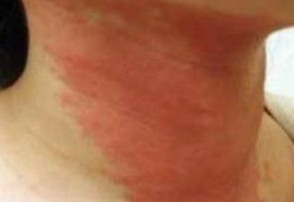 аллергический контактный дерматит фото