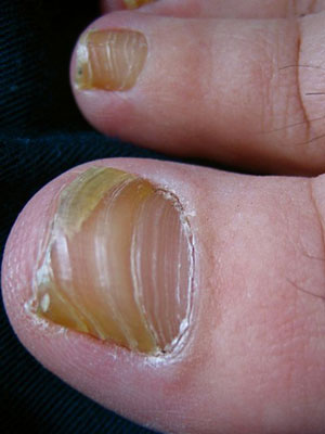 Почему желтеют ногти на ногах? Фото желтых ногтей