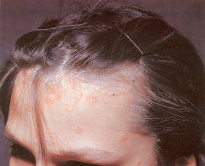 Шелушение кожи головы