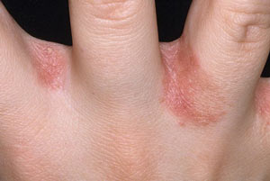 Шелушение кожи на пальцах рук