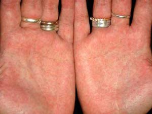 водянистая сыпь на пальцах рук и ладонях