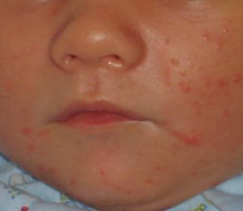 сыпь на лице вокруг рта и на щеках у ребенка