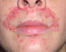 аллергическая сыпь на лице