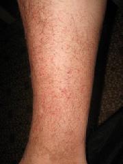 Сыпь на ногах: причины, виды, лечение
