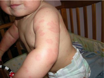 чешется сыпь при аллергии у детей