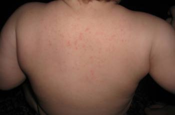 у ребенка красная аллергическая сыпь на спине чешется
