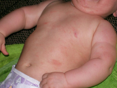 фото сыпь на теле у новорожденного