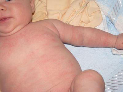 аллергическая сыпь у новорожденных фото