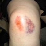 Фото ушиба колена при падении. Синяк и отек на колене