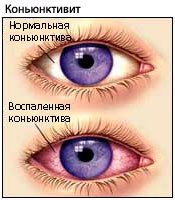 Конъюнктивит - воспаление глаза фото