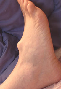 фото жировика на подьеме ноги